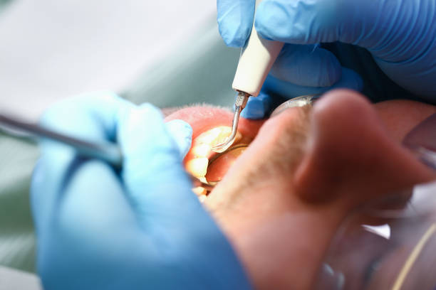 Best Emergency Tooth Extraction in Harvey, MI
